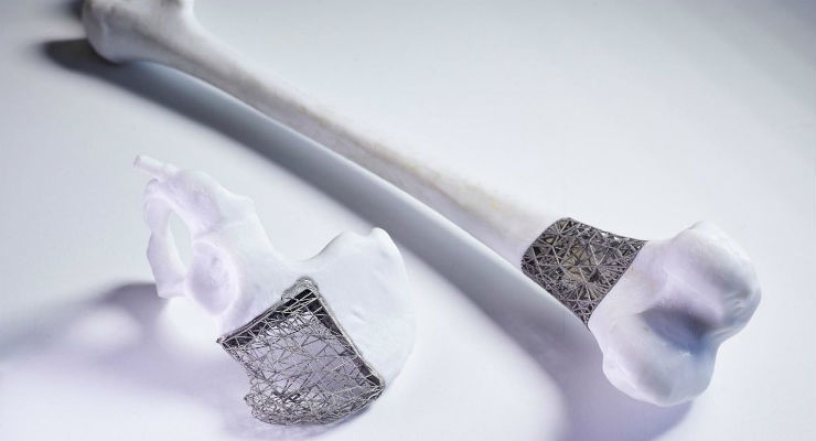 ‘Just-in-Time’ 3D Printed Implants Set to Transform Bone Cancer Surgery